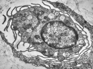 M, 13y. | mast cell